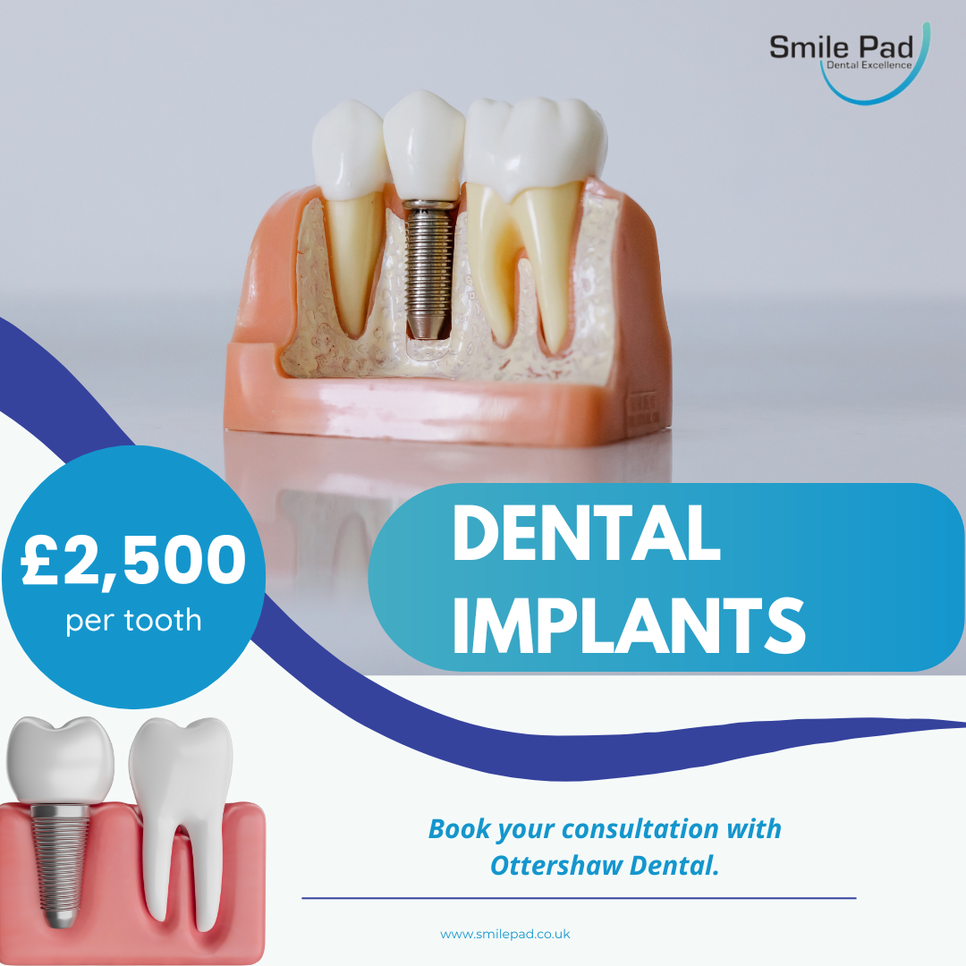 dental implants