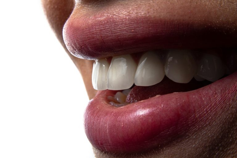 teeth whitening