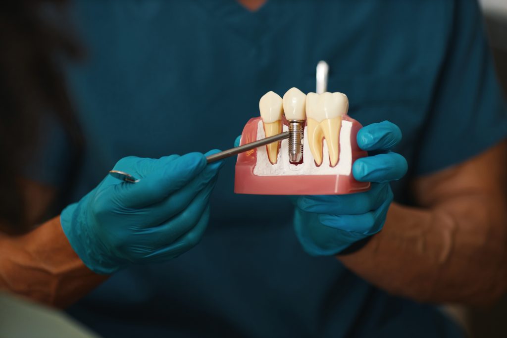 illustrating,dental,implant,procedure,on,model